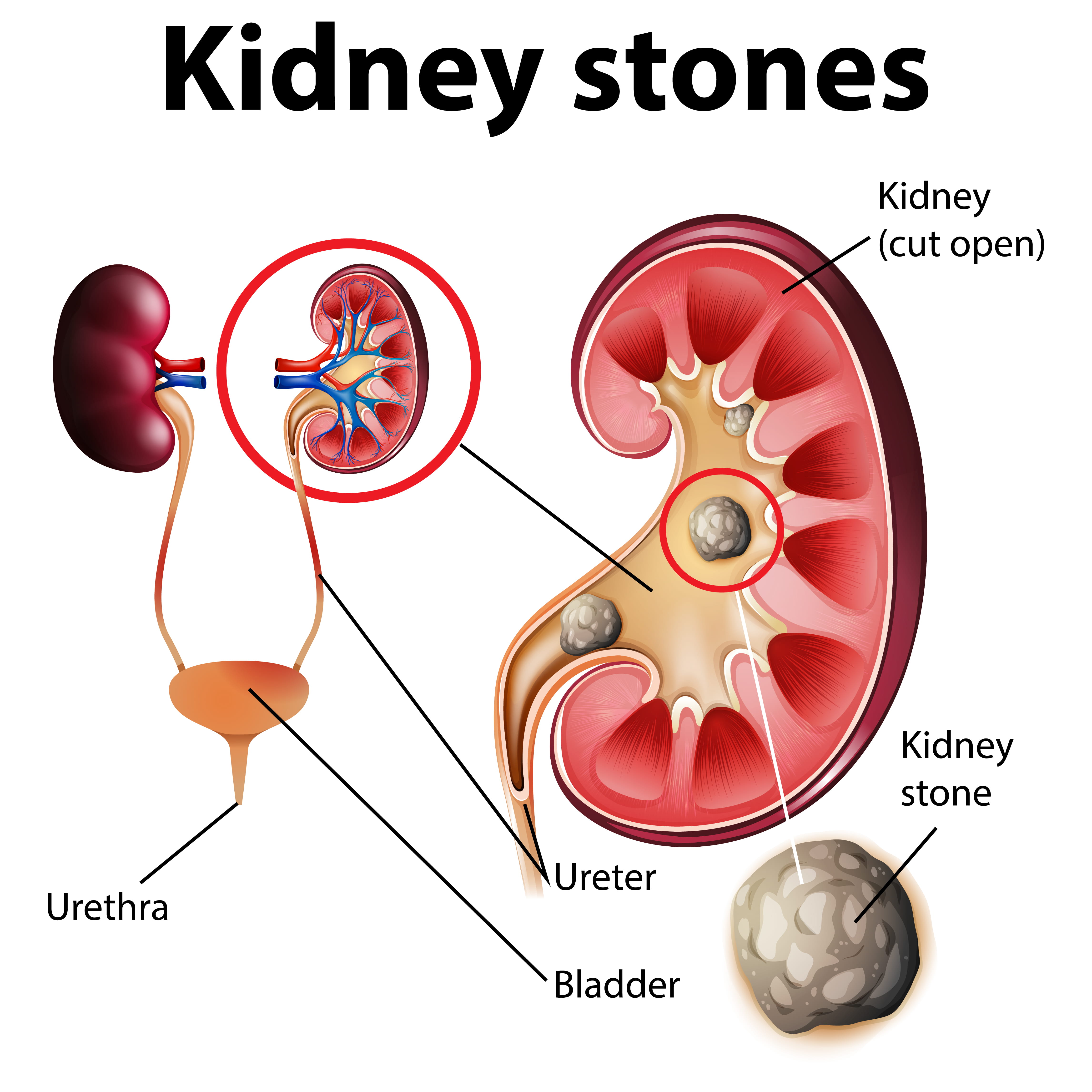 Kidney Stones in North India