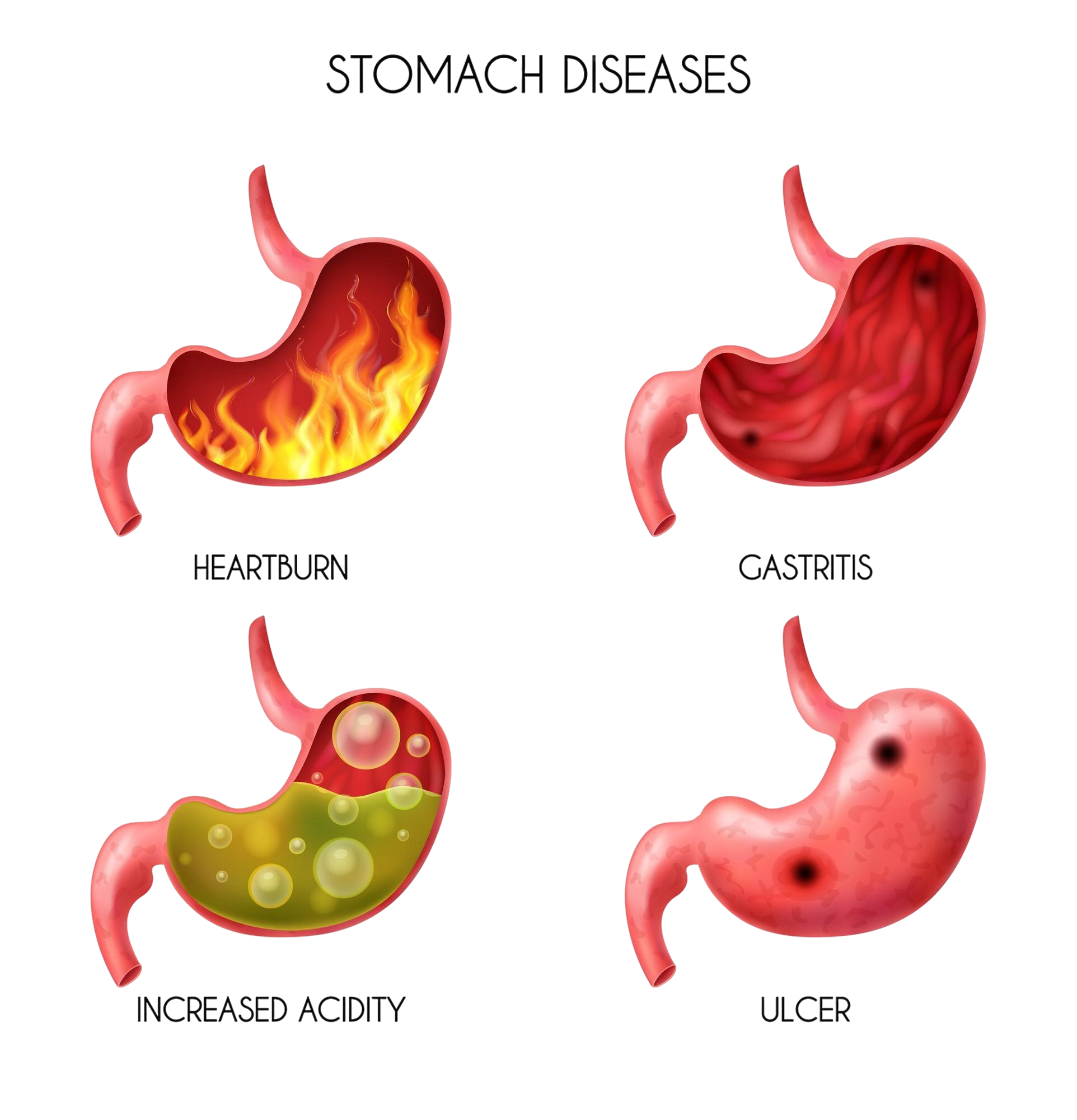 Gastritis & Acidity